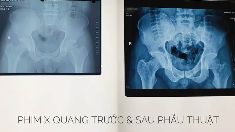 Phẫu thuật lấy gần 100 viên sỏi trong khớp háng nam thanh niên 