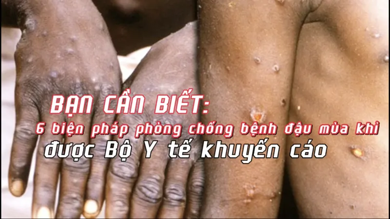Bạn cần biết: 6 biện pháp phòng chống bệnh đậu mùa khỉ được Bộ Y tế khuyến cáo
