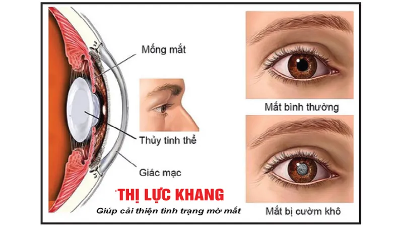 Các bệnh về mắt