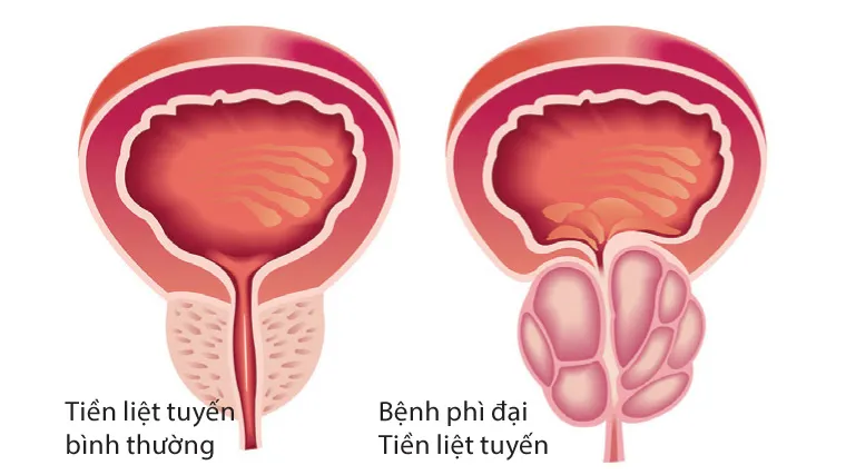 ​Tìm ra lối thoát mới cho bệnh phì đại tiền liệt tuyến