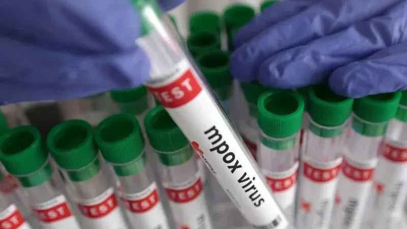 Mẫu xét nghiệm tìm virus gây bệnh đậu mùa khỉ. Ảnh: REUTERS 