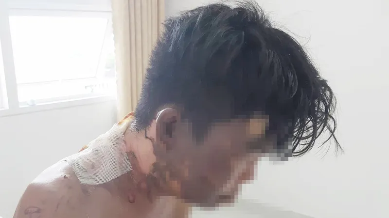 Anh H. bị bỏng nặng