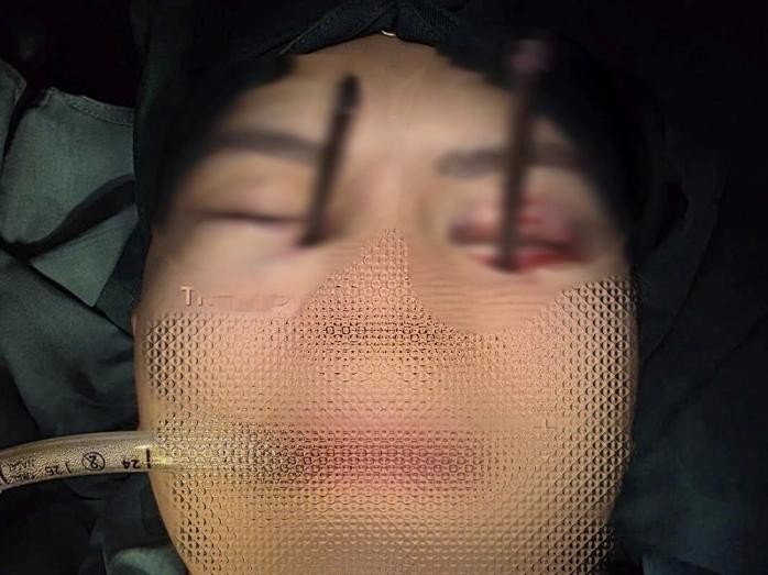 异物为两根深度刺入眼眶的筷子。图：医院提供