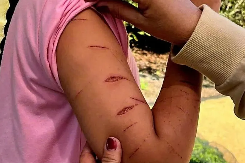 Cà Mau: Phát hiện học sinh lớp 5 đến trường với nhiều vết thương trên cơ thể