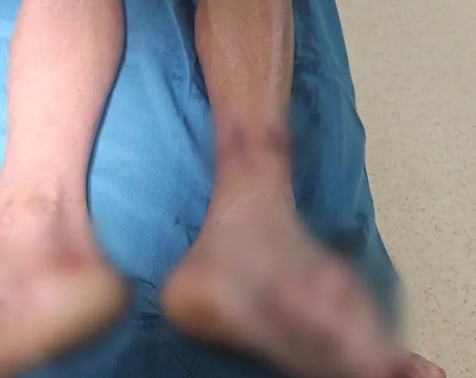 用味精敷腿伤，渔民险些截肢。