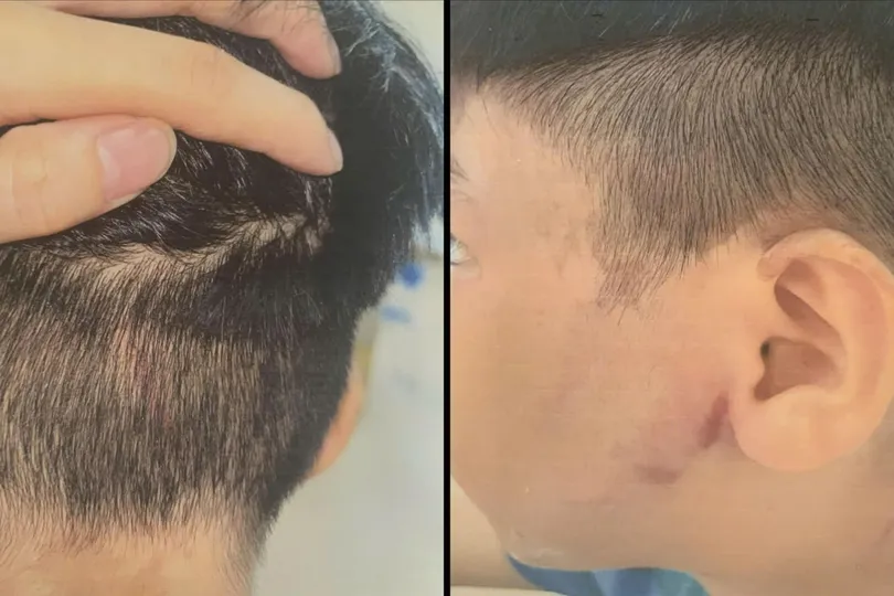 Triệu tập người cha nghi đánh con ruột nhập viện