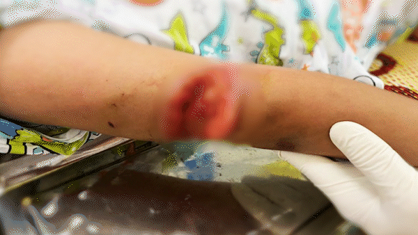 Bé gái 7 tuổi bị chó dữ cắn với nhiều vết thương phức tạp