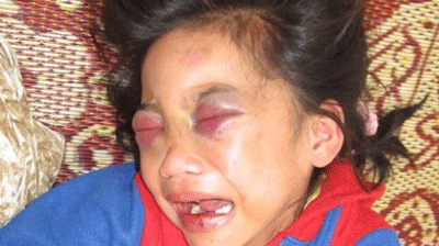 This 10-year-old girl was brutally beaten by her adopted father (Photo: Tuoi tre) This 10-year-old girl was brutally beaten by her adopted father (Photo: Tuoi tre)