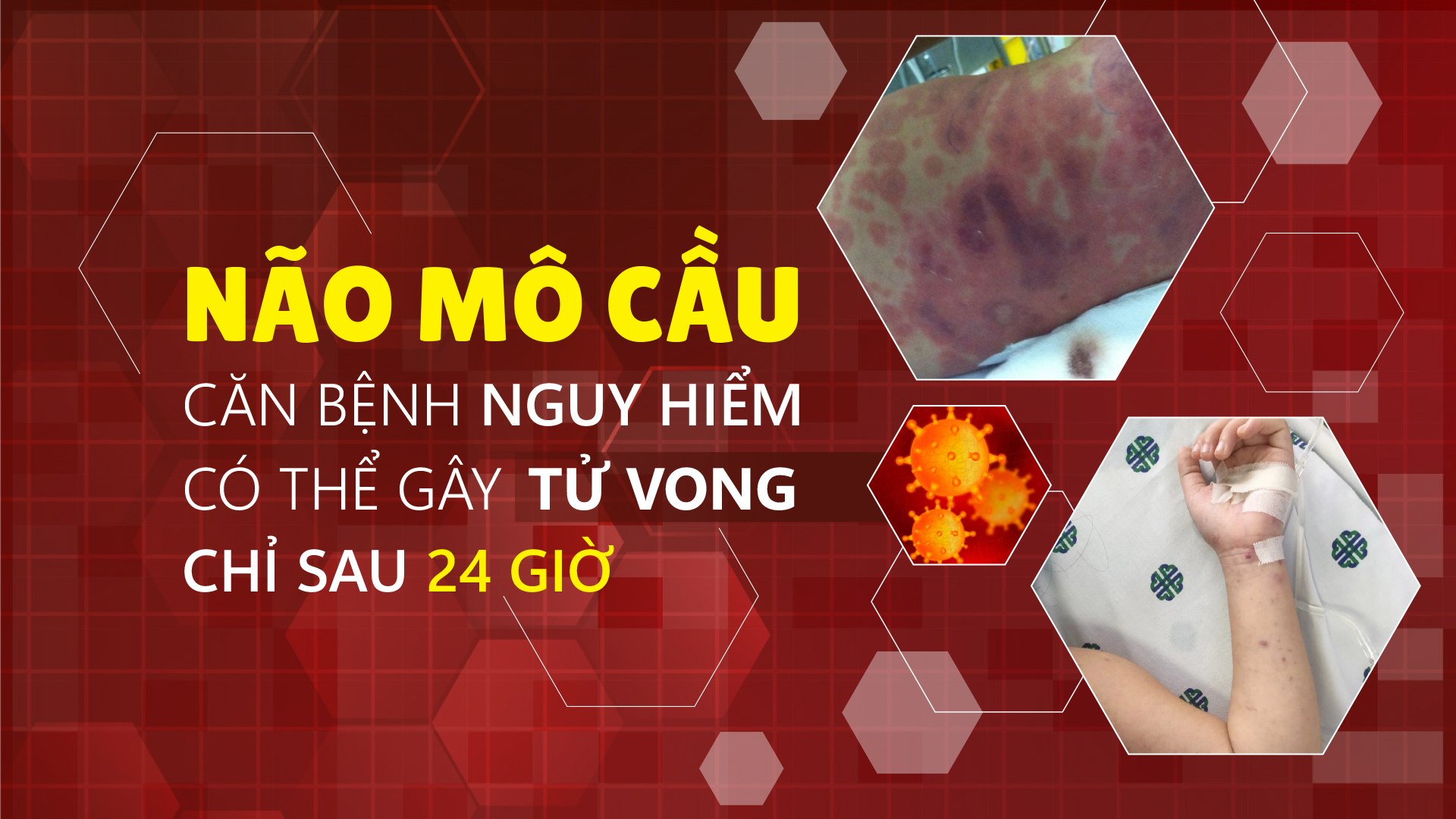 Não mô cầu – Căn bệnh nguy hiểm có thể gây tử vong chỉ sau 24 giờ