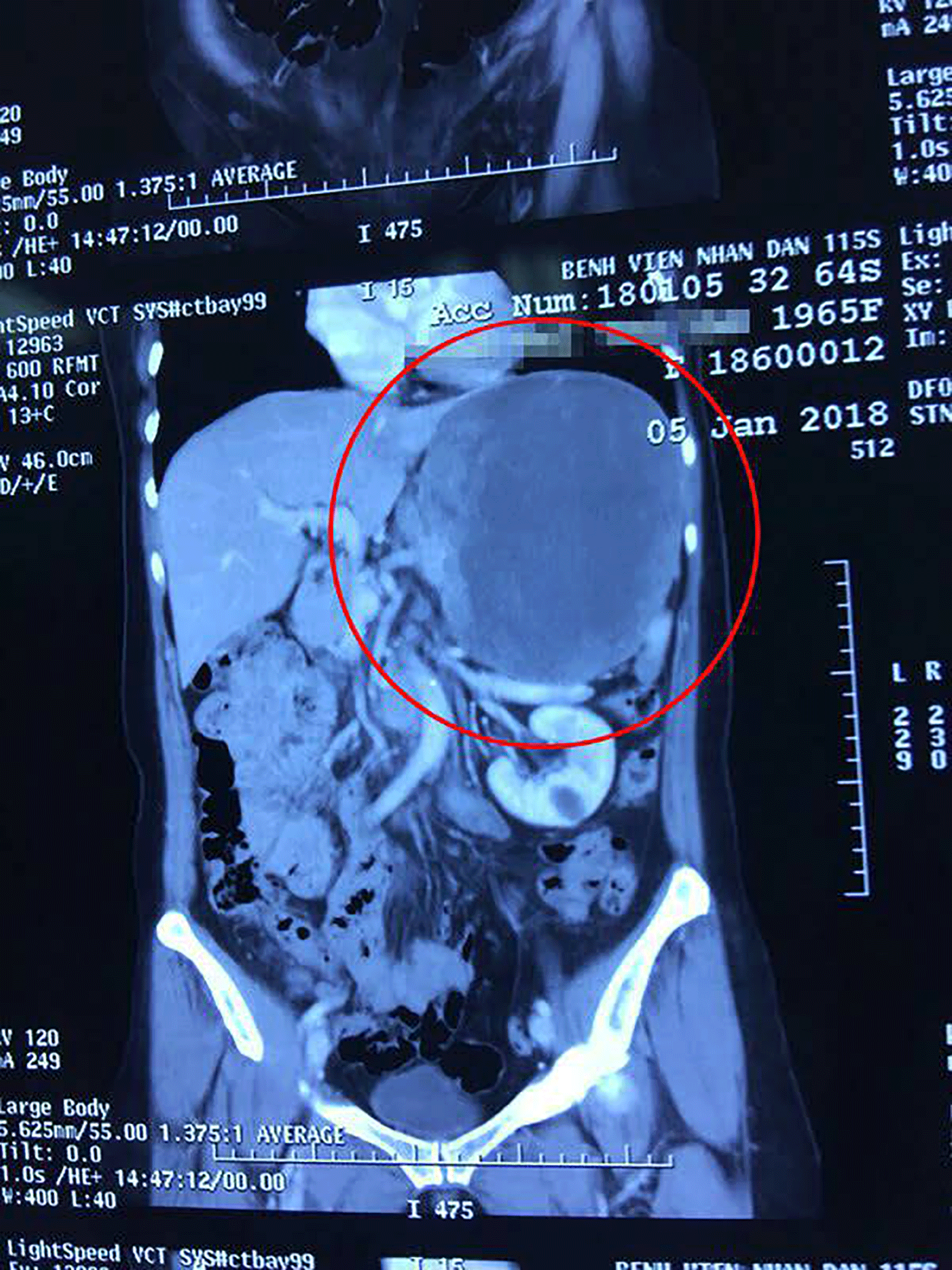 Bóc tách thành công khối u nặng 2kg  ảnh 2