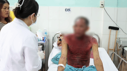 Người bệnh bị phản ứng thuốc hiếm gặp, nguy hiểm sau dùng thuốc nhỏ mắt
