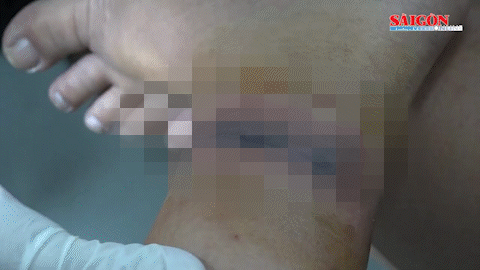 Nhiều người nhập viện vì sứa biển