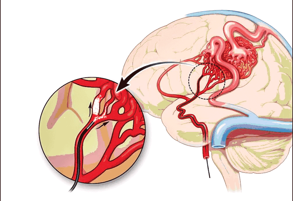 Dị dạng mạch máu não: Nguy cơ tử vong và tàn phế cao ảnh 2