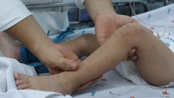 Bệnh tay chân miệng gia tăng, nhiều ca trở nặng