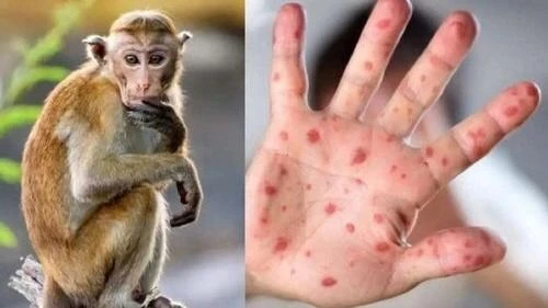 Tiền Giang: Phát hiện ca bệnh đậu mùa khỉ đầu tiên 