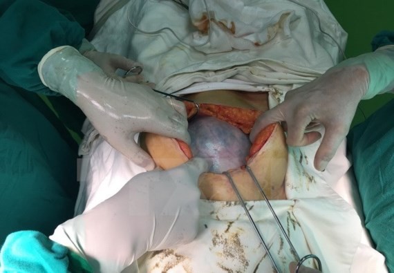 Surgeons carry out the operation to remove the ovarian cyst (Photo: SGGP)