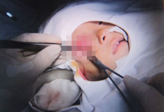 The baby undergoes a surgery to remove abscess from the eye socket (Photo: SGGP)