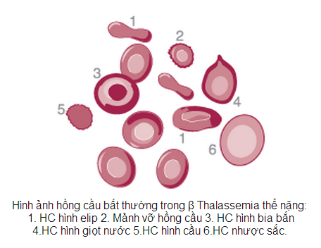 Woman with Thalassemia has a healthy son