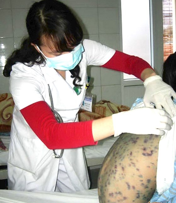 Medical workers warn peak season of chickenpox