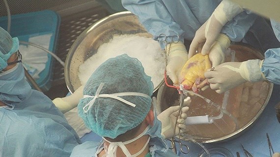 Surgeons perfom heart transplant on 53 year old man in Thua Thien - Hue province (Photo: SGGP)