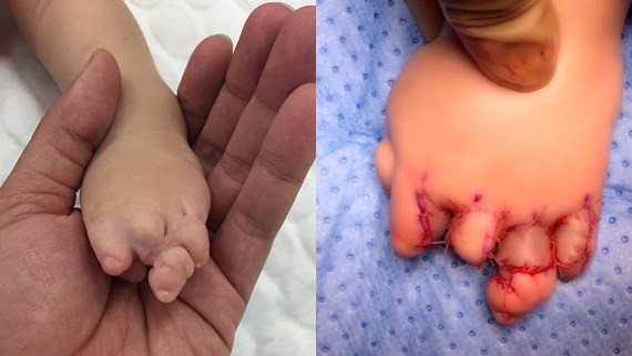 Surgeons perform operation on kid with congenital constriction ring syndrome