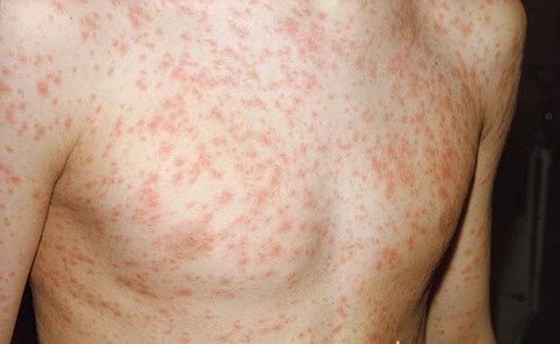 Measles outbreaks continue to escalate in South Vietnam