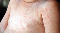 Sixty measles cases reported in first week of 2019 in HCMC