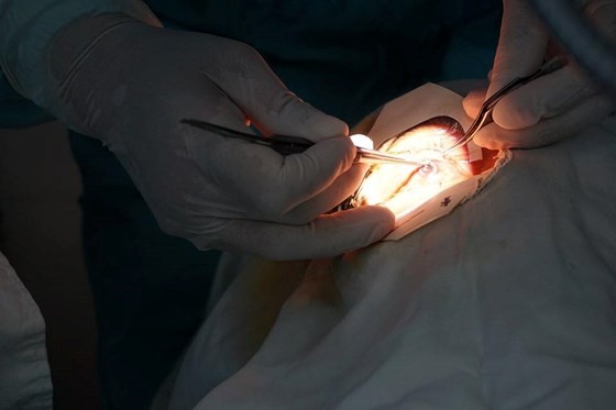 Two blind men can see after corneal graft
