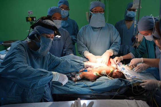 Conjoined twins sharing a liver separated after four-hour surgery