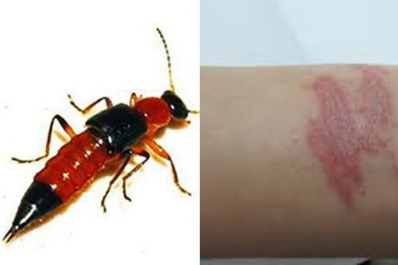 Hanoi on alert after hospitalizations due to rove beetles attacks