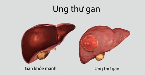 Liver cancer kills about 25,000 people yearly in Vietnam