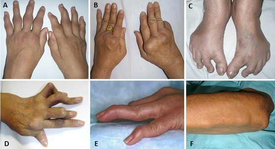 Number of Vietnamese rheumatoid arthritis patients escalating