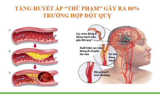 25 percent of Vietnam’s population have heart disease, high blood pressure