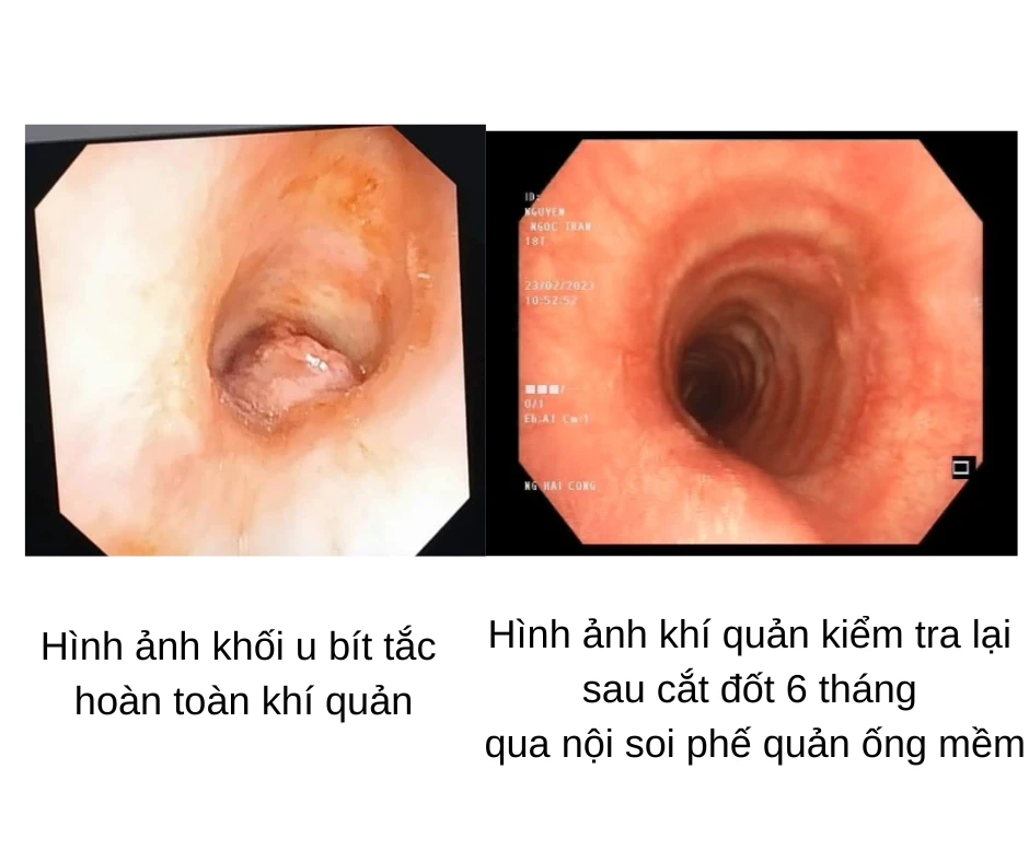 Coi chừng bít tắc khí quản do polyp 