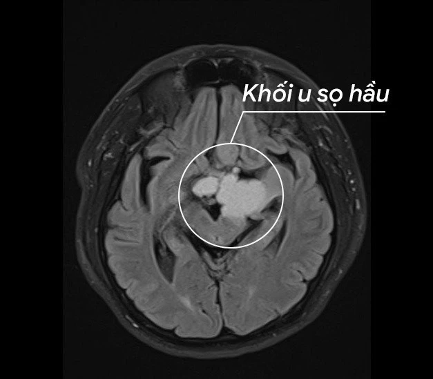 Khối u sọ hầu trong não bệnh nhân