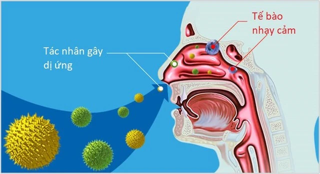 Gia tăng bệnh nhân mắc viêm mũi xoang do ô nhiễm không khí