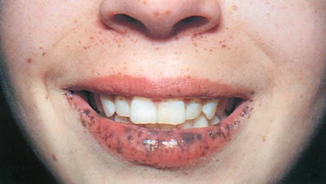 Phát hiện bệnh từ các nốt sắc tố trong miệng