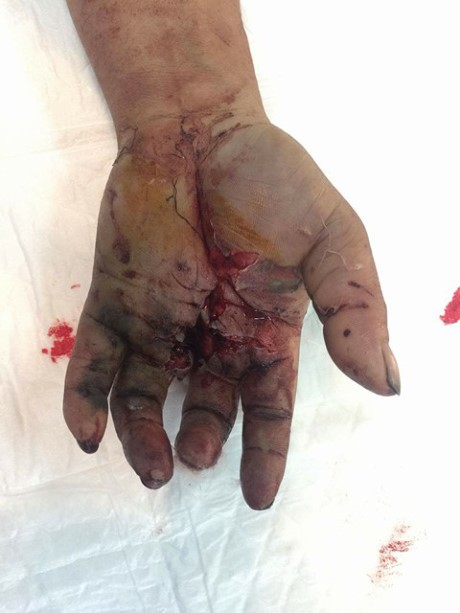 病人其左手掌受了重傷。（圖源：互聯網）