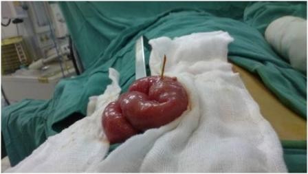 圖為接受手術中的胃腸道穿孔之嬰兒阮裴芳翠。（圖源：互聯網）
