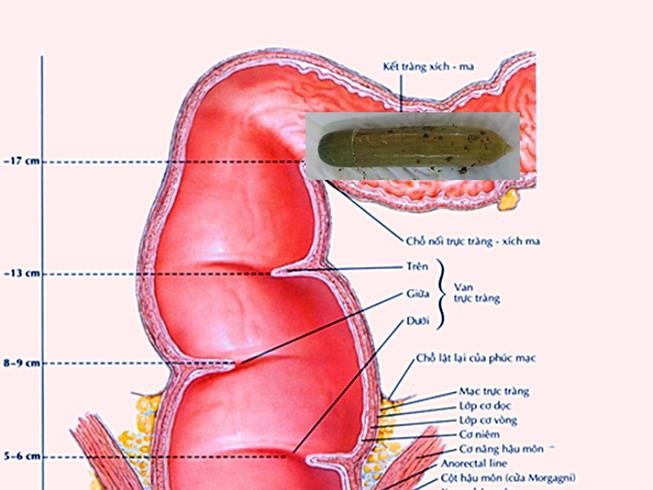 黃瓜位於乙狀結腸示意圖。