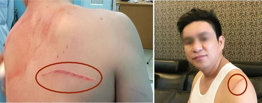 詹國泰醫生身上的傷口與傷痕。（圖源：互聯網）