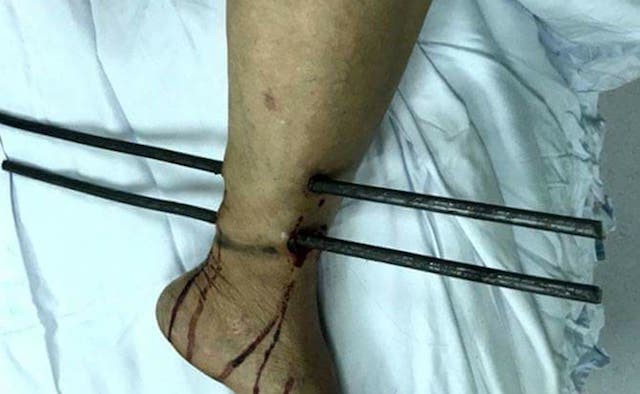 病人送至醫院時小腿被兩根鐵條插穿的情況。（圖源：K120醫院提供）