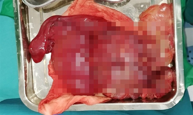 手術切割取出的淋巴管瘤。（圖源：醫院提供）