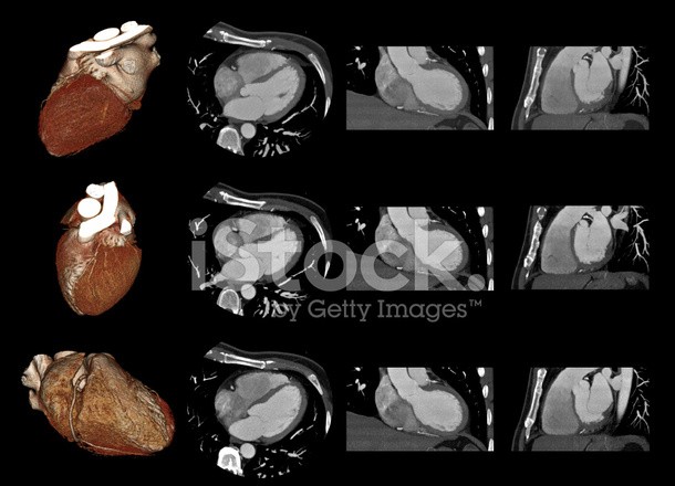 CT 血管造影檢查有助及早發現心臟病。（示意圖源：Getty Images）