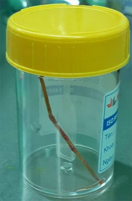 經內窺鏡手術從患者的小腸取出長約6釐米的牙籤。（圖源：醫院提供）