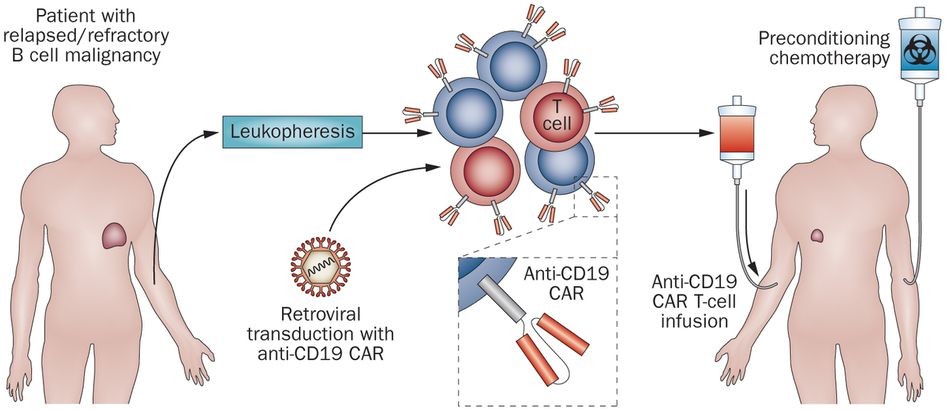 CAR-T 細胞免疫療法示意圖。