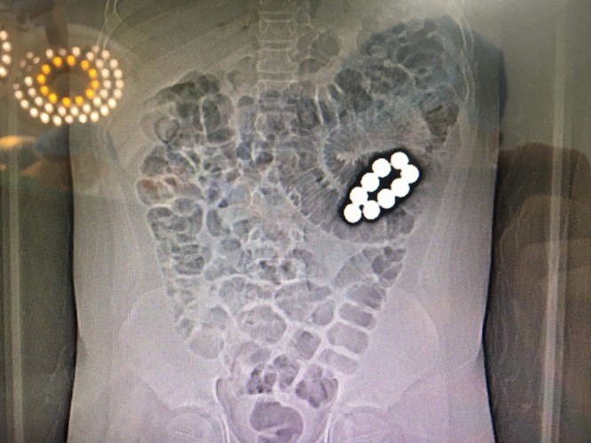經腹部CT掃描顯出病童腹內的9顆異物位置。（圖源：醫院提供）