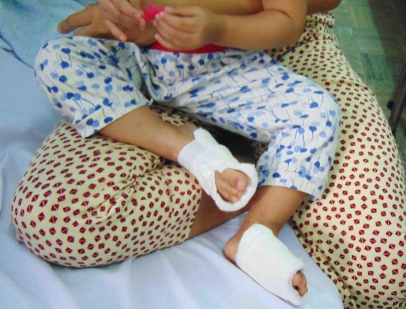 兩腳被燙傷的18月齡兒童還在治療中。（圖源：陳玉）