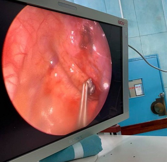 內窺鏡手術取彈過程視頻截圖。（圖源：林瑞）