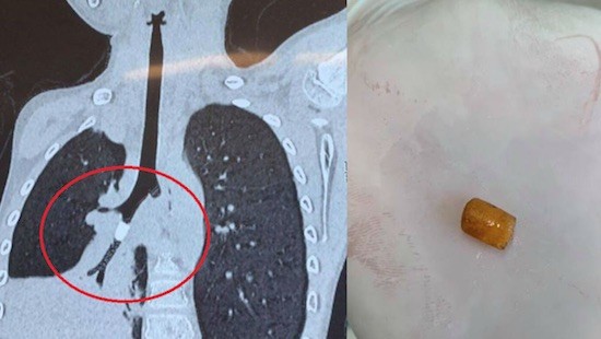 左圖：胸部CT斷層掃描結果顯示支氣管內有圓柱形物體，導致支氣管分支S9外基底段完全堵塞。右圖：經支氣管鏡取出的“塑料硬物”。（圖源：志心）